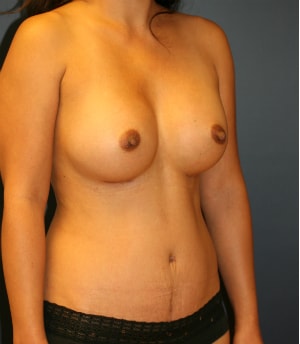 A result from Feel Beautiful Plastic Surgery San Diego, Steve Laverson MD