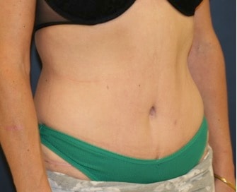A result from Feel Beautiful Plastic Surgery San Diego, Steve Laverson MD