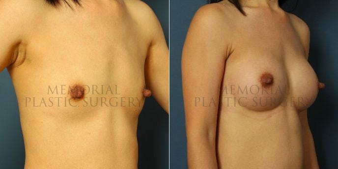 A result from Memorial Plastic Surgery
