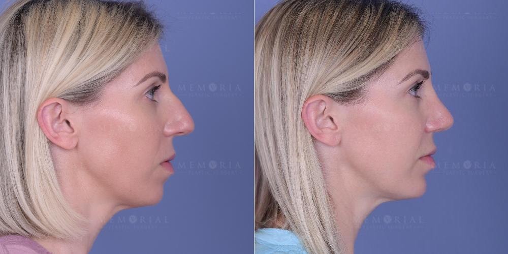 A result from Memorial Plastic Surgery