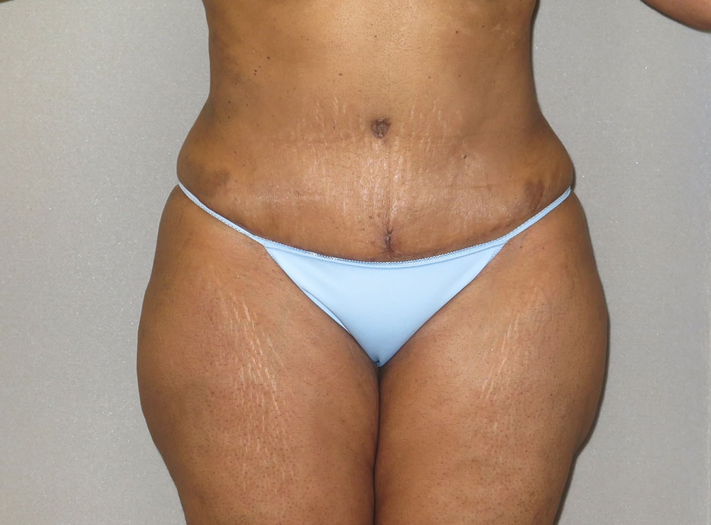 A result from The Aesthetic Institute of Chicago (Brian M. Braithwaite, MD)