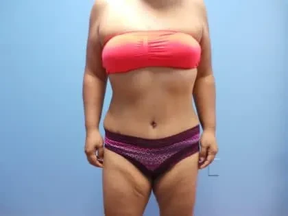 A result from Cosmetic Plastic Surgery & Wellness Club of Maryland